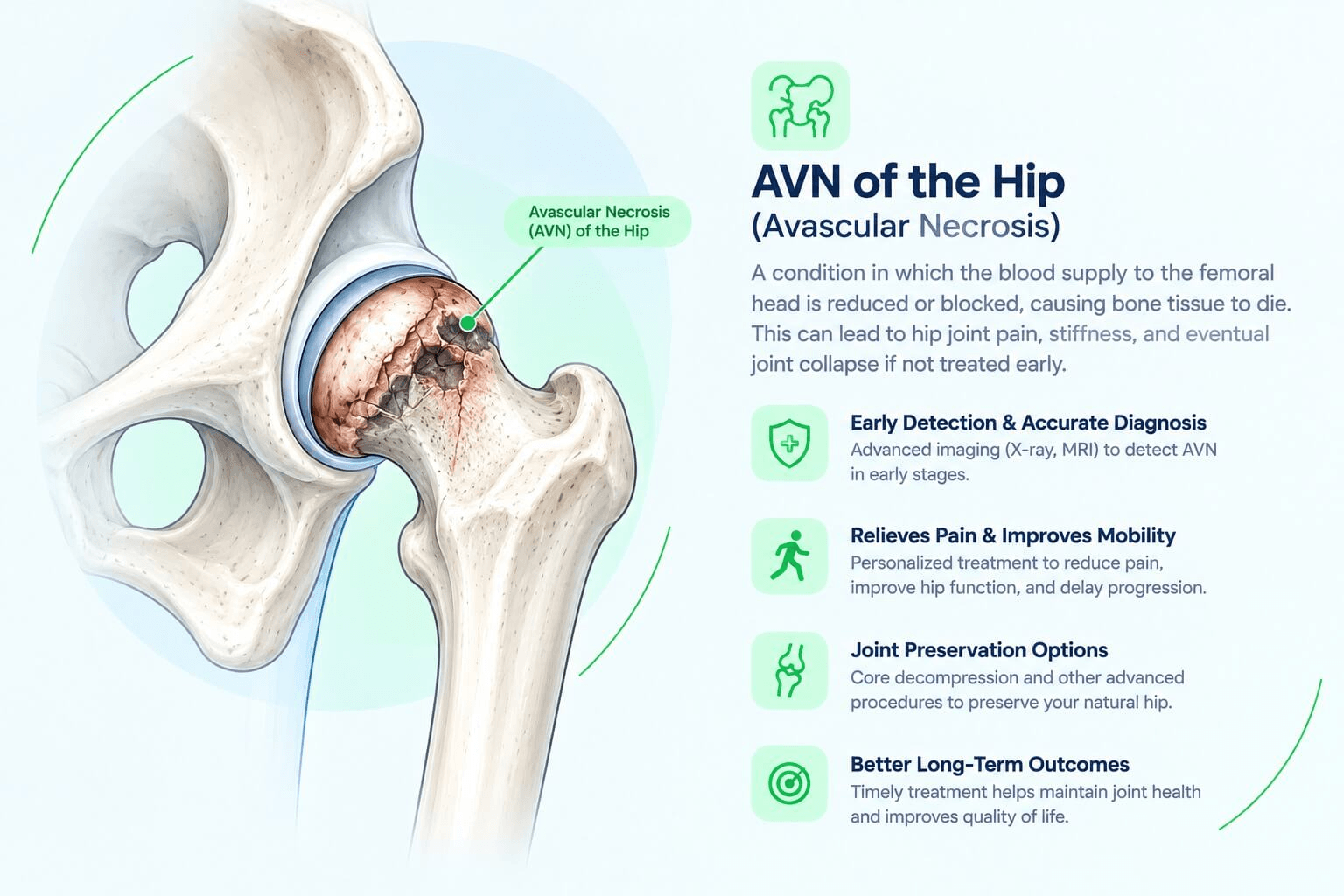 Illustration of avascular necrosis affecting the head of the hip bone
