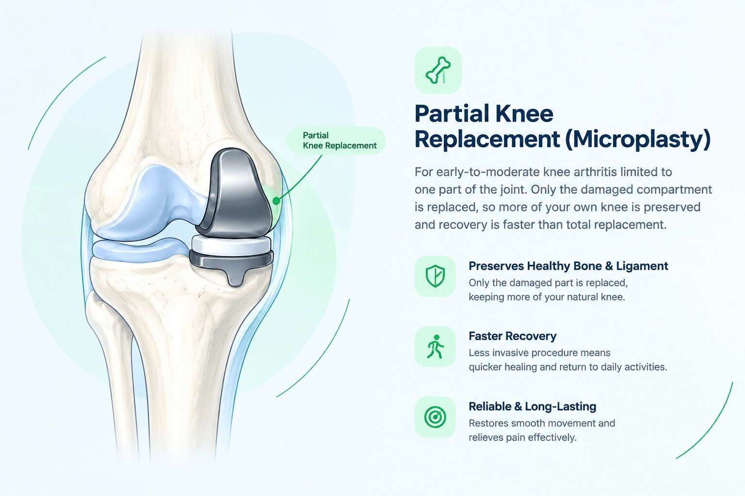 Illustration of a partial knee replacement implant resurfacing one compartment of the knee joint