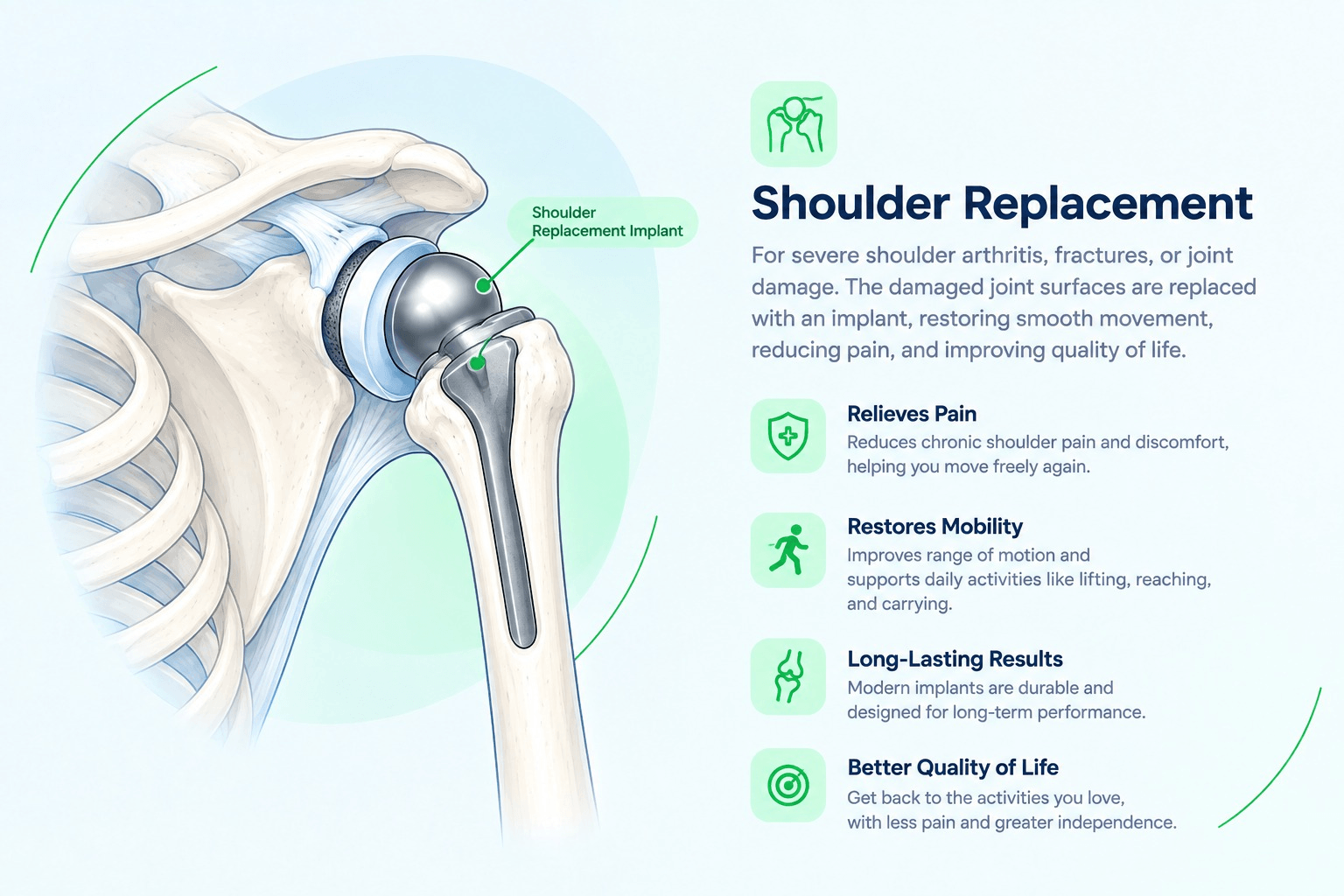 Illustration of a shoulder replacement implant in the shoulder joint